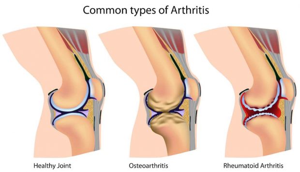 Você sabe o que é Osteoartrite? Conheça o problema e como ele ocorre